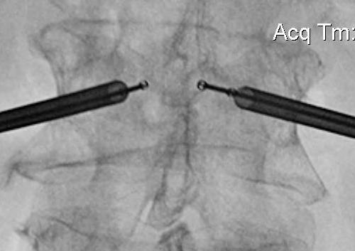 Kyphoplasty Insertion